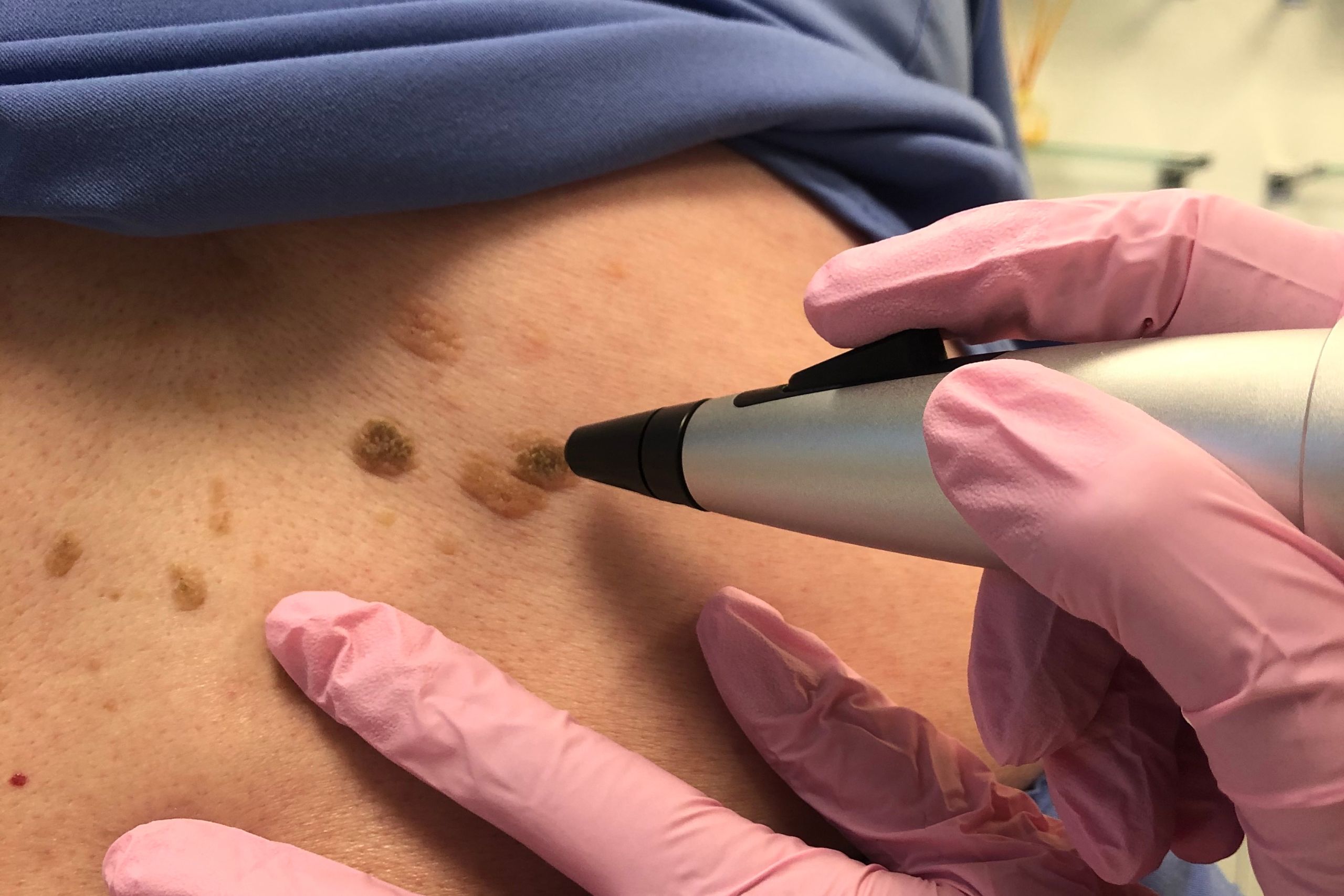 Aspire mole clinic booking now
