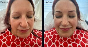 Aspire eyebrow patient